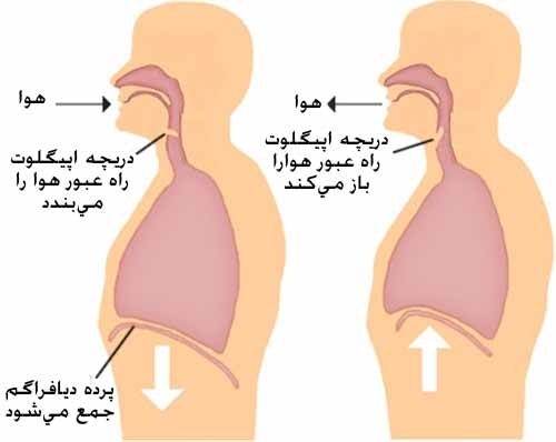 رابطه سکسکه و سکته مغزی